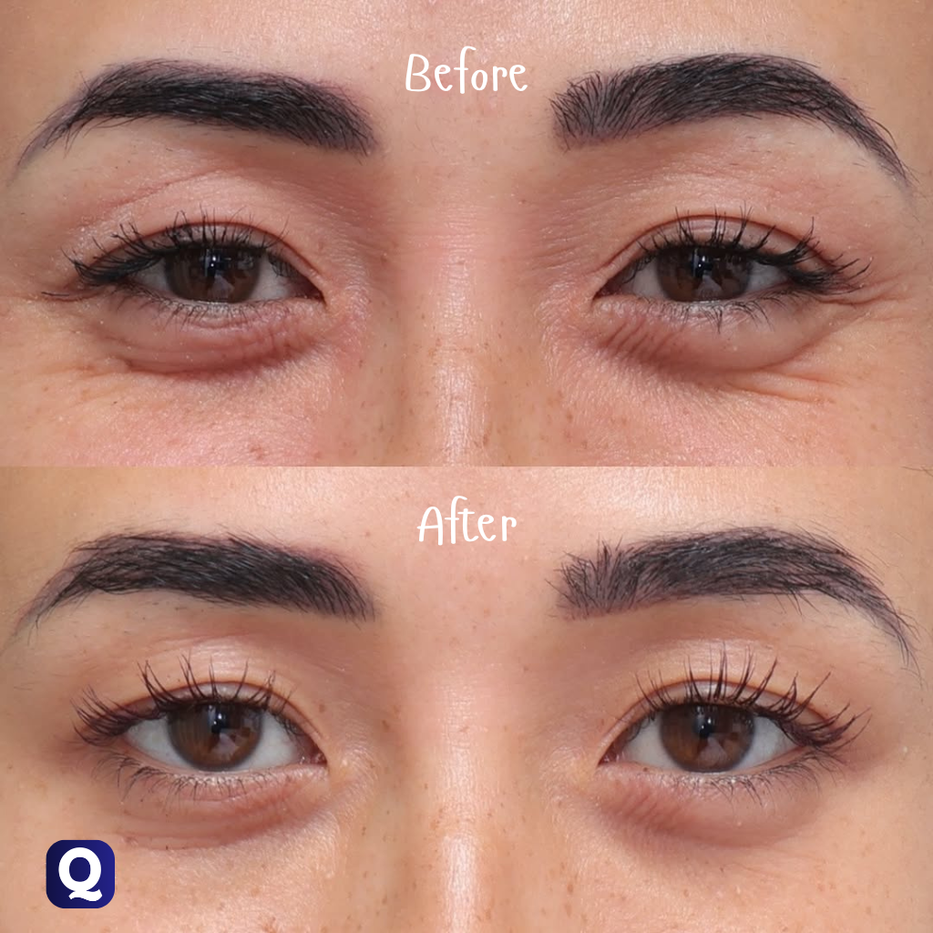 Quistara™ | Wrinkle Remover Roller 50ML (Pack of 2)