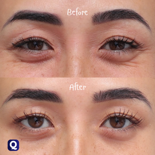 Quistara™ | Wrinkle Remover Roller 50ML (Pack of 2)