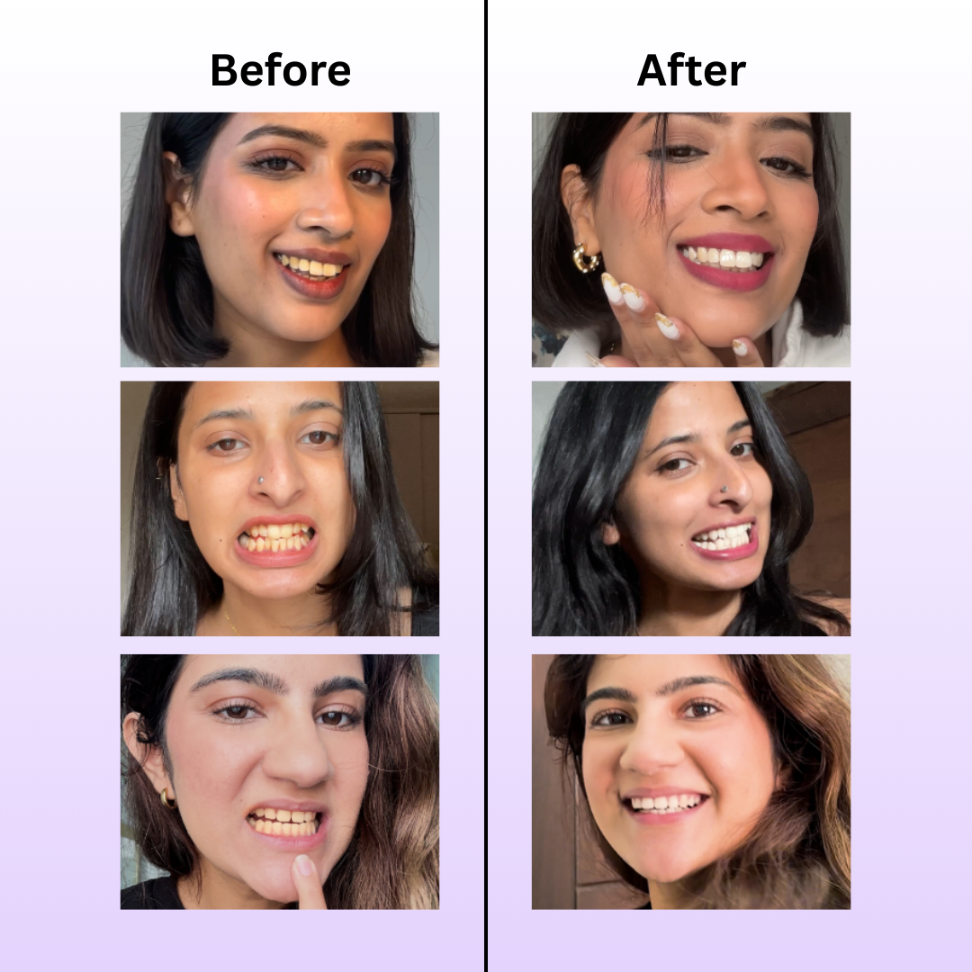 Teeth Whitening Serum (Pack of 2)