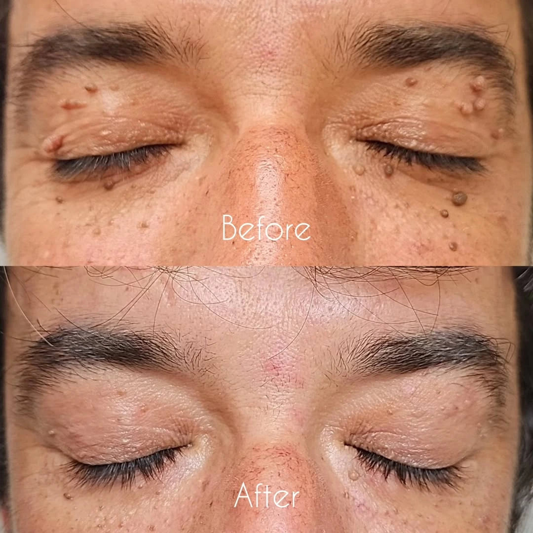 Quistara™ | No More Skin Tags